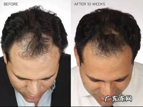 怎样生发最有效