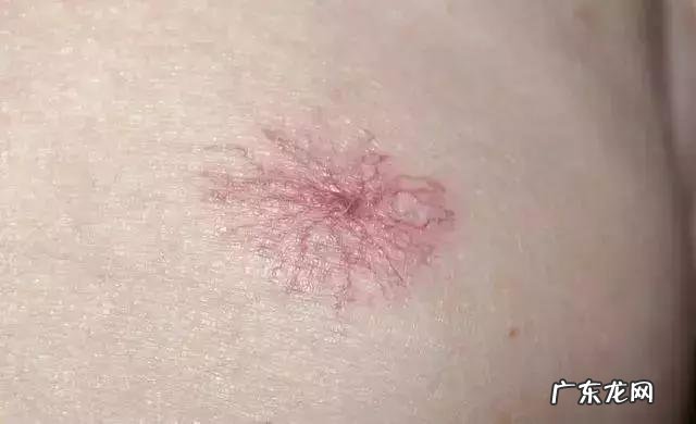 血痣和红痣的区别