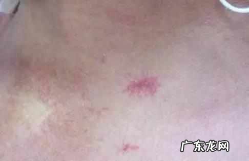 血痣和红痣的区别