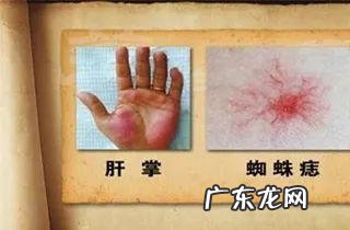 血痣和红痣的区别图片