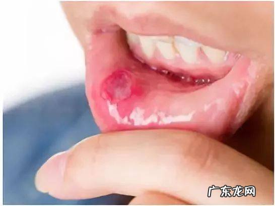 5个小妙招巧治口腔溃疡