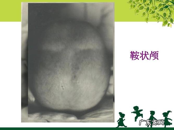 佝偻病的症状图片大全